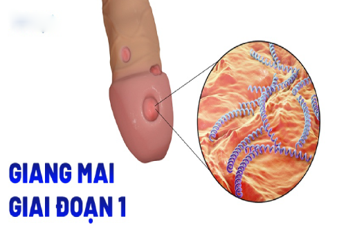 Bệnh Giang Mai Giai Đoạn 1 Có Thể Chữa Dứt Điểm Không?