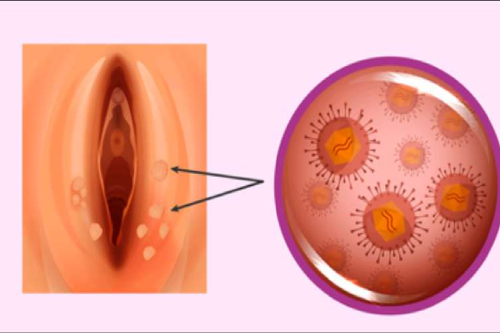 Bệnh Sùi Mào Gà Ở Bộ Phận Sinh Dục Nữ Có Chữa Được Không? Bệnh Sùi Mào Gà Ở Bộ Phận Sinh Dục Nữ Có Chữa Được Không?