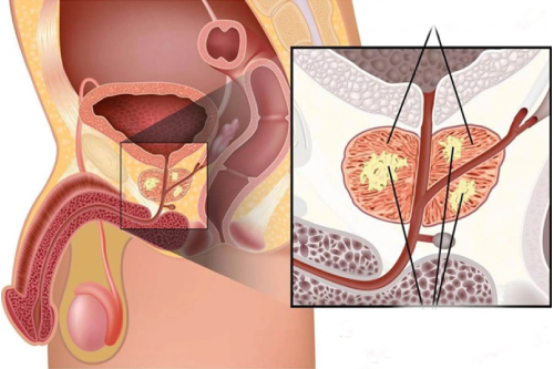 Bệnh Vôi Hoá Tuyến Tiền Liệt Có Nguy Hiểm Không Pleiku Gia Lai
