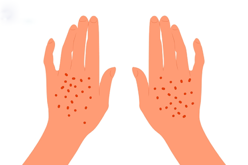 Các Phương Pháp Xét Nghiệm Bệnh Giang Mai Hiệu Qủa 2025