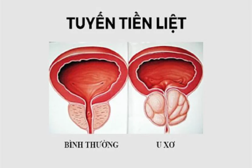 Cách Nhận Biết U Xơ Tuyến Tiền Liệt Nam Giới Gia Lai