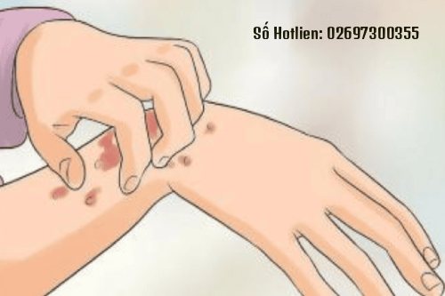 Loét Sinh Dục Do Xoắn Khuẩn Giang Mai Có Nguy Hiểm Không KomTum?