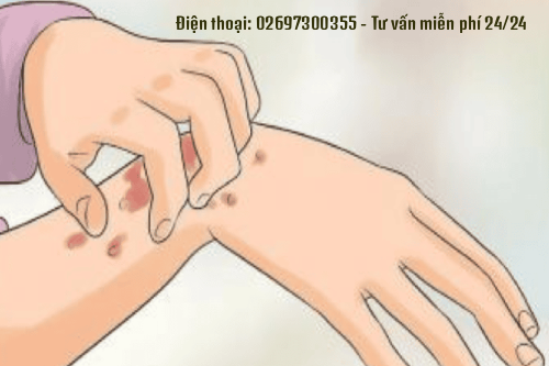 Mắc Bệnh Giang Mai Giai Đoạn Cuối Sống Được Bao Lâu Gia Lai?