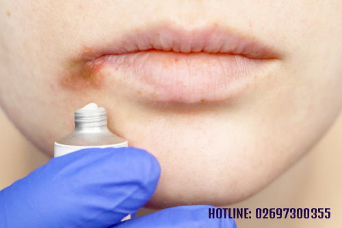 Mọc Mụn Nước Ở Môi Có Phải Dấu Hiệu Của Mụn Rộp Sinh Dục Pleiku Gia Lai