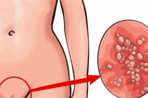 Những Dấu Hiệu Mắc Bệnh Sùi Mào Gà Ở Bộ Phận Sinh Dục Nữ Giới Pleiku