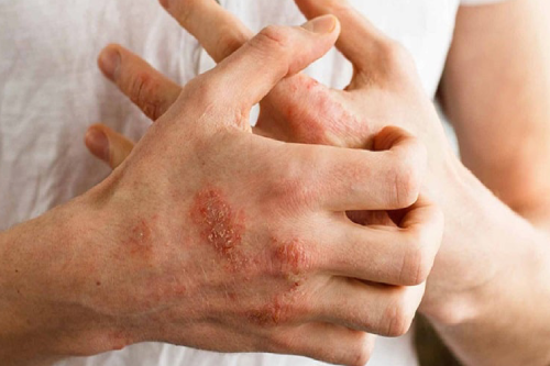 Những Điều Cần Biết Về Bệnh Lý Herpes Sinh Sinh Dục Pleiku Gia Lai