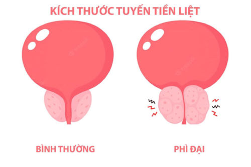 Phương Pháp Điều Trị Phì Đại Tuyến Tiền Liệt Hiệu Qủa Gia Lai