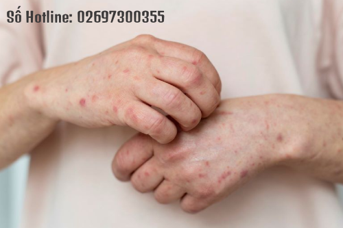 Săng Giang Mai Là Gì? Dấu Hiệu Nhận Biết Và Cách Điều Trị Hiệu Qủa Tại Gia Lai