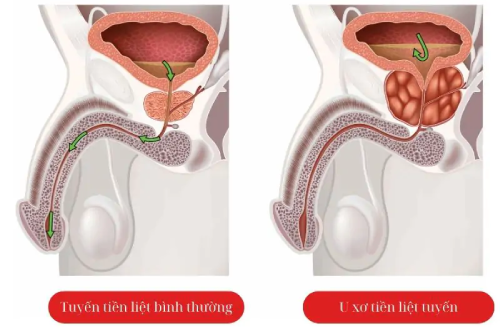 U Xơ Tuyến Tiền Liệt Là Gì? Nguyên Nhân, Dấu Hiệu, Cách Điều Trị