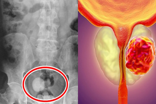 Vôi Hóa Tuyến Tiền Liệt Ảnh Hưởng Đến Sức Khỏe Nam Giới Như Thế Nào?